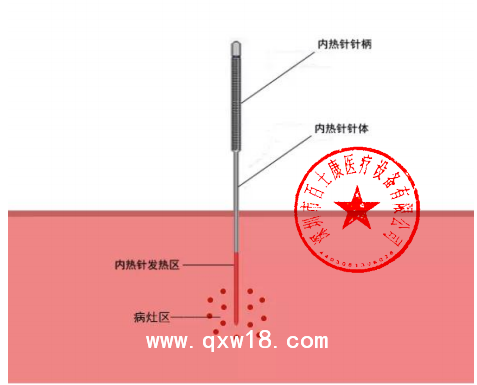 百士康生產(chǎn)廠家1.1mm*140mm 內(nèi)熱針 內(nèi)熱式針灸針