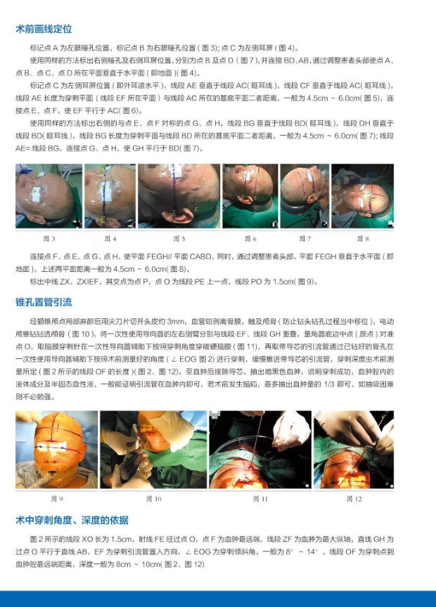 一次性使用導向器（腦血管穿刺定位）
